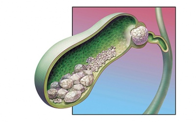 Nhiều sỏi túi mật, chưa đau dùng TPBVSK Kim Đởm Khang được không?