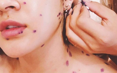 5 thực phẩm bạn cần tránh khi bị thủy đậu