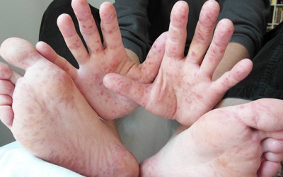 Biến chứng của bệnh tay chân miệng nguy hiểm thế nào?