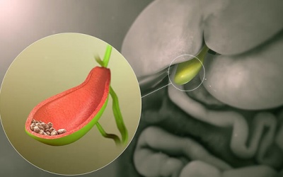 Sỏi túi mật 5mm nên điều trị thế nào?