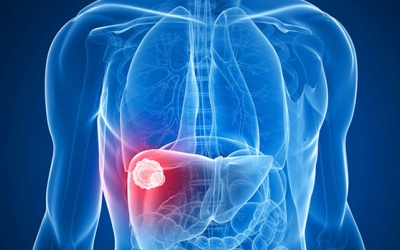 Ung thư biểu mô tế bào gan điều trị thế nào?