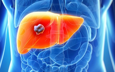 Sỏi gan 5mm dùng TPBVSK Kim Đởm Khang được không?