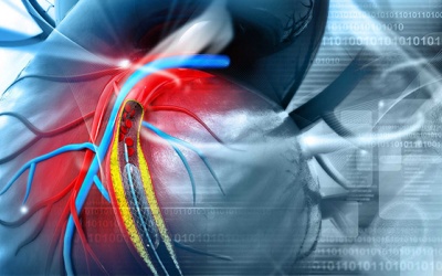 Xơ vữa, hẹp mạch vành 50% có nặng không, cần phẫu thuật chưa?