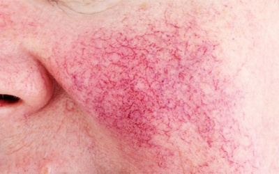 7 biện pháp tự nhiên giúp kiểm soát bệnh rosacea tại nhà