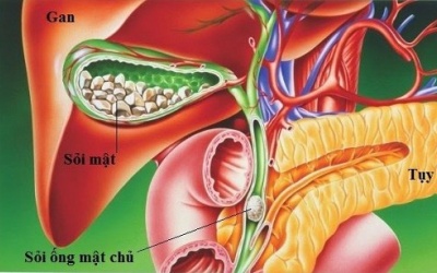 Sỏi ống mật chủ 36x12mm dùng TPBVSK Kim Đởm Khang được không?