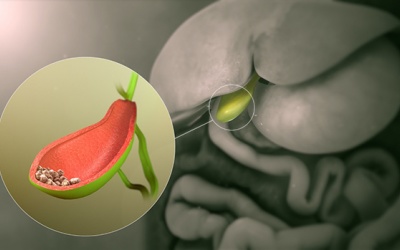 Nguyên nhân, triệu chứng và cách điều trị viêm túi mật hoại tử