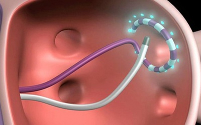 Tổng quan về phương pháp đốt điện tim trị rối loạn nhịp tim