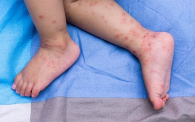 Trẻ bị tay chân miệng cần kiêng gì để nhanh khỏi bệnh? 