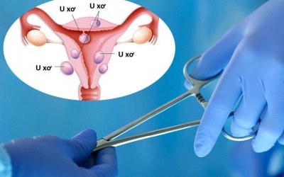 Bị u xơ tử cung khi nào cần mổ?