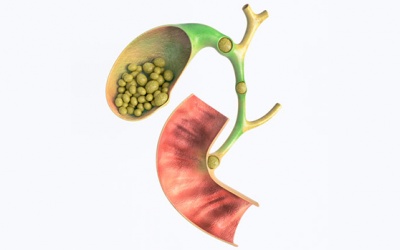 Sỏi mật 20mm dùng TPBVSK Kim Đởm Khang hỗ trợ được không?