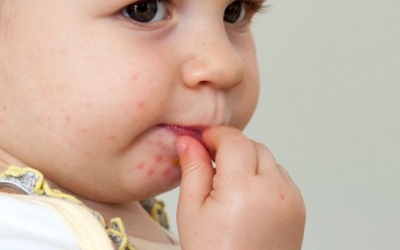 6 điều cha mẹ nên biết về bệnh tay chân miệng