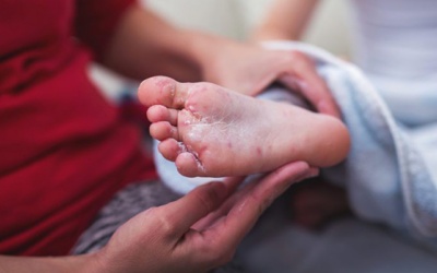 Trẻ đã mắc tay chân miệng có bị lại không?