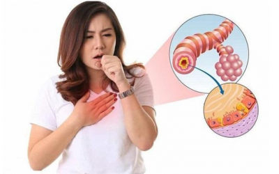 Cải thiện tình trạng ho kéo dài do viêm phế quản nhờ sản phẩm thảo dược