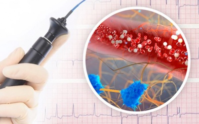 Đốt điện tim trị ngoại tâm thu có rủi ro gì, làm sao ngừa tái phát?