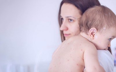 Những bệnh có thể khiến trẻ nổi mụn nước, bóng nước trên da