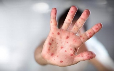 Cách cải thiện bệnh tay chân miệng bằng thảo dược