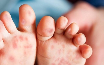 Một vài sai lầm thường gặp khi chăm sóc trẻ bị tay chân miệng