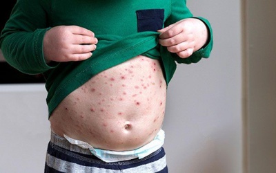 Trẻ bị thủy đậu nên ăn gì?