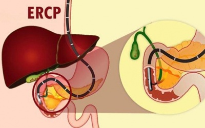 Chụp mật tuỵ ngược dòng qua nội soi là gì, thực hiện thế nào?