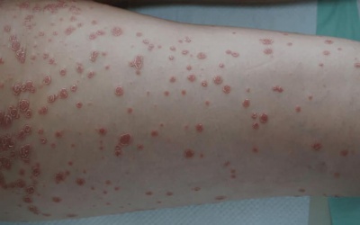 Cách kiểm soát bệnh vảy nến thể giọt an toàn, hiệu quả