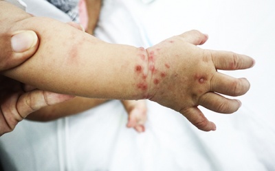 Trẻ bị tay chân miệng nên tắm như thế nào? 