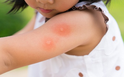 Một vài lưu ý khi chăm trẻ bị sốt xuất huyết tại nhà 