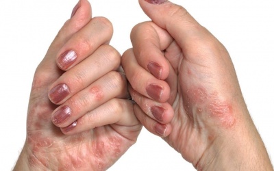 Bệnh vảy nến ở tay có lây không? 