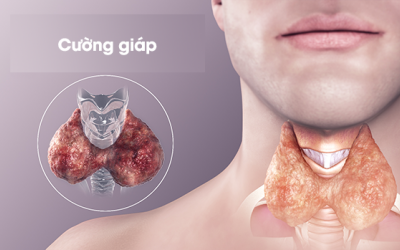 Phương pháp hỗ trợ cải thiện cường giáp từ thảo dược