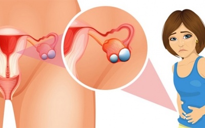 Cải thiện u nang buồng trứng bằng sản phẩm thảo dược 