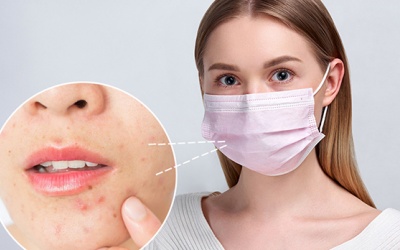 Ngăn ngừa mụn khi đeo khẩu trang thường xuyên