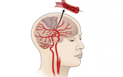 Tại sao nên dùng nattokinase để phòng ngừa và cải thiện đột quỵ não do cục máu đông?