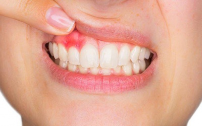 Tại sao người bị viêm lợi nên sử dụng giải pháp thiên nhiên?