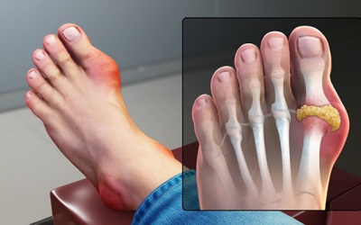 Giảm cơn đau gout an toàn, hiệu quả nhờ sản phẩm thảo dược