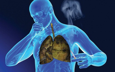 Sử dụng thảo dược để hỗ trợ ngăn ngừa ung thư phổi tái phát