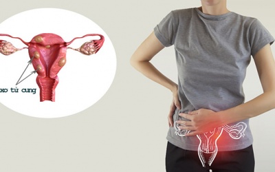 Cải thiện u xơ tử cung bằng sản phẩm thảo dược 