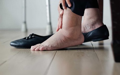 Tại sao người bệnh suy tim bị phù, giữ nước trong cơ thể?