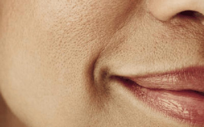 5 lý do không ngờ khiến lỗ chân lông to