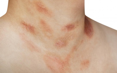 Làm thế nào để cải thiện tình trạng vảy phấn hồng trên da?