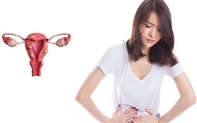 Nguyên nhân gây u xơ tử cung và cách cải thiện hiệu quả từ thảo dược