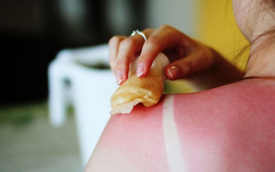 Biện pháp “cấp cứu” làn da cháy nắng đỏ rát