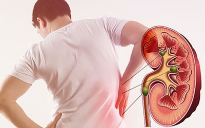 Người bị suy thận độ 2 nên và không nên ăn gì để giảm nguy cơ chạy thận?