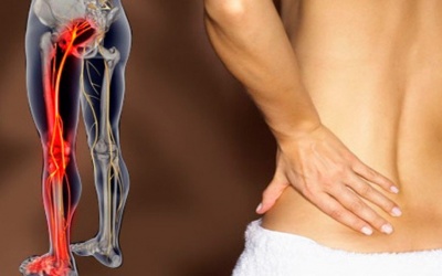 Giải pháp cải thiện đau thần kinh tọa hiệu quả, an toàn từ tự nhiên 