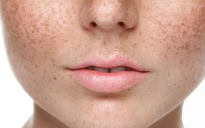 Nám da khi mang thai: Nguyên nhân và giải pháp