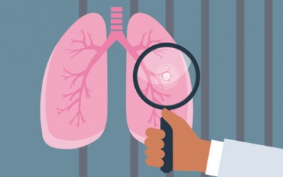 Những đối tượng nguy cơ cao, cần sớm tầm soát ung thư phổi 