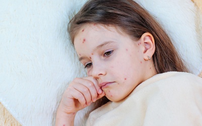 Phòng ngừa thủy đậu lây lan bằng cách nào?