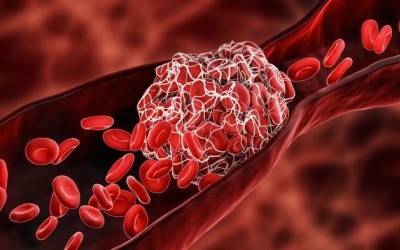 Đã tìm ra nguyên nhân hình thành cục máu đông ở bệnh nhân COVID-19