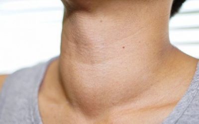 Làm sao để cải thiện tình trạng cường giáp an toàn, hiệu quả?