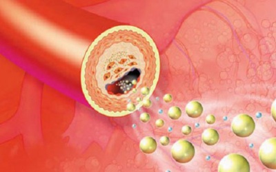 Cải thiện rối loạn lipid máu bằng sản phẩm thảo dược 