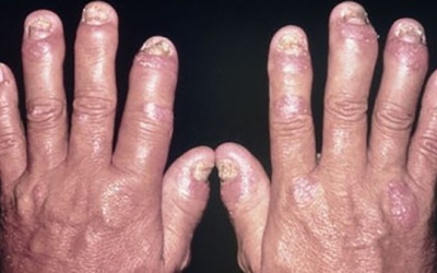 Giải pháp cải thiện vảy nến thể khớp an toàn, hiệu quả