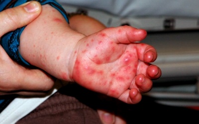 Bí kíp cải thiện bệnh tay chân miệng hiệu quả bằng thảo dược